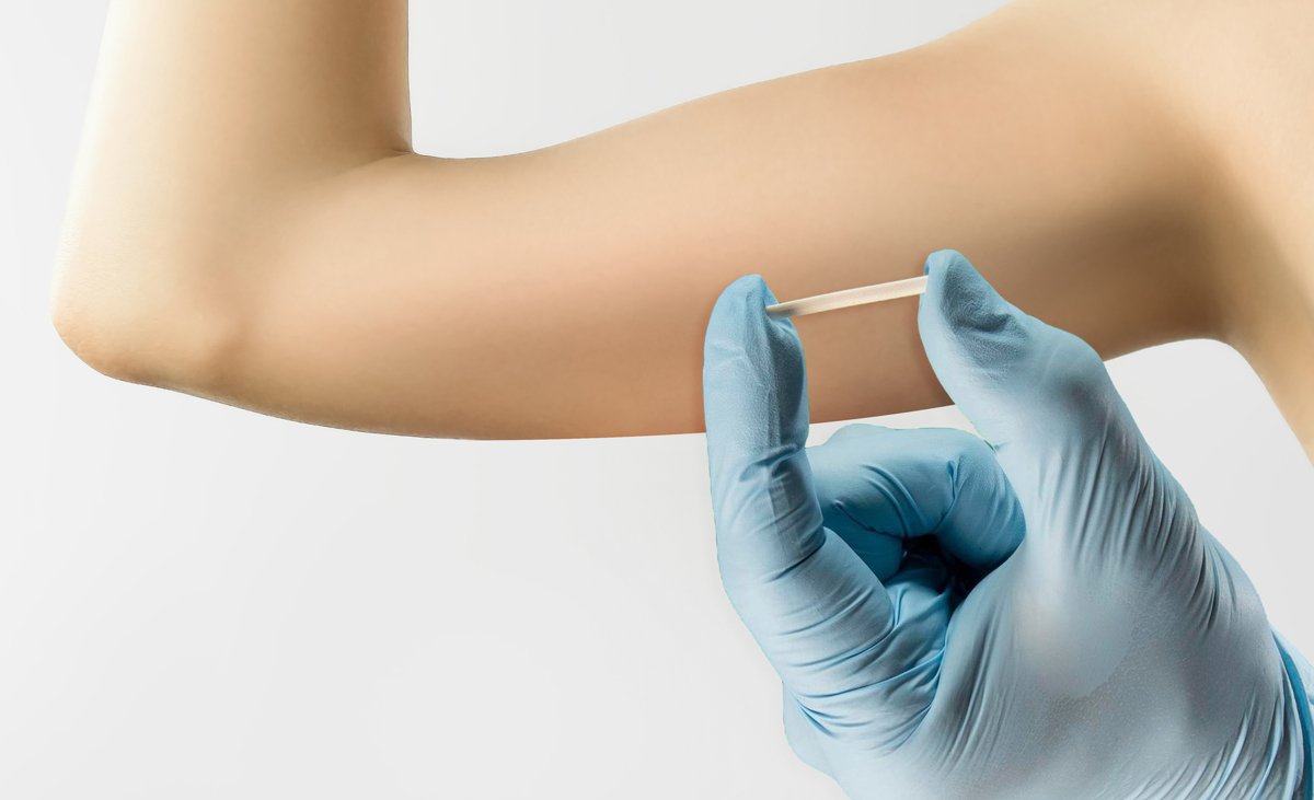 SUS disponibiliza implante anticoncepcional de longa duração para mulheres de 14 a 49 anos em São Gonçalo